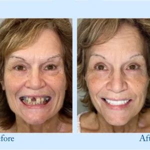 𝐇𝐢𝐝𝐨𝐧𝐞® 🦷Advanced Customized Full Denture Set🦷 (⏰Limited time discount last 30 minutes⏰)💎