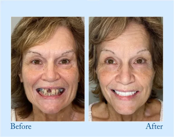 𝐇𝐢𝐝𝐨𝐧𝐞® 🦷Advanced Customized Full Denture Set🦷 (⏰Limited time discount last 30 minutes⏰)💎