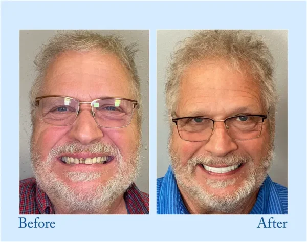 𝐇𝐢𝐝𝐨𝐧𝐞® 🦷Advanced Customized Full Denture Set🦷 (⏰Limited time discount last 30 minutes⏰)💎