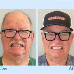 𝐇𝐢𝐝𝐨𝐧𝐞® 🦷Advanced Customized Full Denture Set🦷 (⏰Limited time discount last 30 minutes⏰)💎
