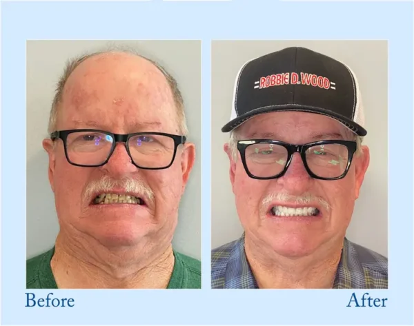 𝐇𝐢𝐝𝐨𝐧𝐞® 🦷Advanced Customized Full Denture Set🦷 (⏰Limited time discount last 30 minutes⏰)💎