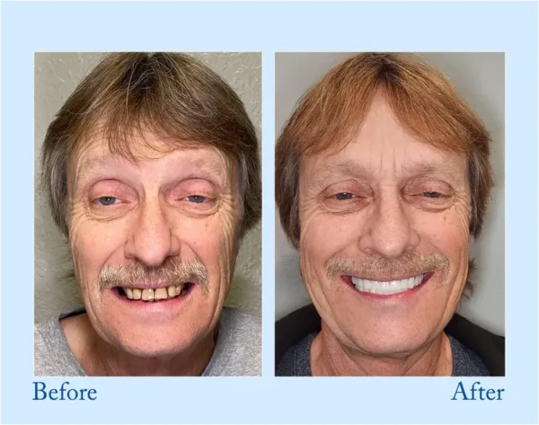 𝐇𝐢𝐝𝐨𝐧𝐞® 🦷Advanced Customized Full Denture Set🦷 (⏰Limited time discount last 30 minutes⏰)💎
