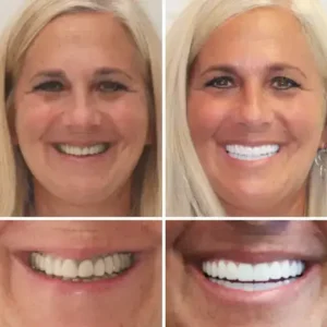HZA™ –🦷Advanced Customized Full Denture Set