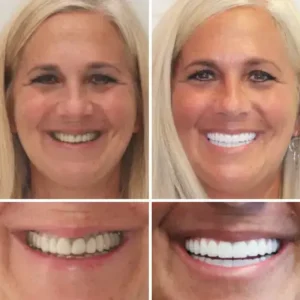 Hidone® Full Denture Set🦷🦷💃Advanced Self-Adjusting Dental Materials (⏰Limited time discount last 30 minutes⏰)