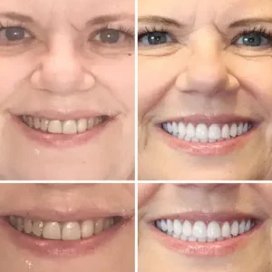 Hidone® Full Denture Set🦷🦷💃Advanced Self-Adjusting Dental Materials (⏰Limited time discount last 30 minutes⏰)