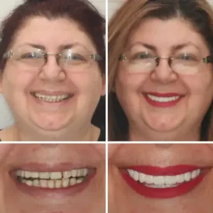 Hidone® Full Denture Set🦷🦷💃Advanced Self-Adjusting Dental Materials (⏰Limited time discount last 30 minutes⏰)