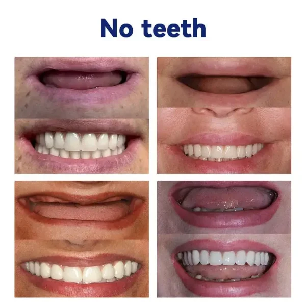 SmileFitPro™-New Generation Flexible Full Denture Solution