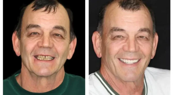 Smileasego™ -🦷Advanced Customized Full Denture Set🦷 (⏰Limited time discount last 30 minutes⏰)