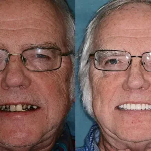 Smileasego™ -🦷Advanced Customized Full Denture Set🦷 (⏰Limited time discount last 30 minutes⏰)