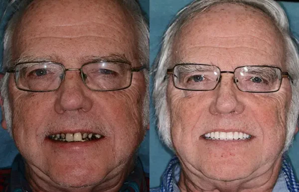 Smileasego™ -🦷Advanced Customized Full Denture Set🦷 (⏰Limited time discount last 30 minutes⏰)