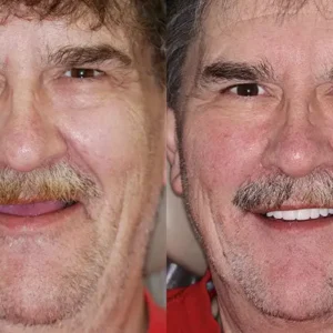 Smileasego™ -🦷Advanced Customized Full Denture Set🦷 (⏰Limited time discount last 30 minutes⏰)