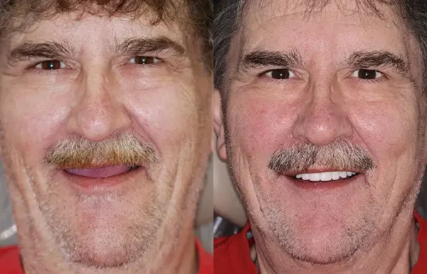 Smileasego™ -🦷Advanced Customized Full Denture Set🦷 (⏰Limited time discount last 30 minutes⏰)