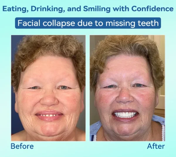 𝐁𝐢𝐤𝐞𝐧𝐝𝐚®🌍𝐏𝐫𝐞𝐦𝐢𝐮𝐦 𝐅𝐮𝐥𝐥 𝐒𝐞𝐭 𝐃𝐞𝐧𝐭𝐮𝐫𝐞𝐬 – 𝐍𝐚𝐭𝐮𝐫𝐚𝐥 𝐂𝐨𝐦𝐟𝐨𝐫𝐭, 𝐔𝐧𝐛𝐞𝐚𝐭𝐚𝐛𝐥𝐞 𝐅𝐢𝐭(🦷𝐋𝐢𝐦𝐢𝐭𝐞𝐝 𝐭𝐢𝐦𝐞 𝐝𝐢𝐬𝐜𝐨𝐮𝐧𝐭 𝐋𝐚𝐬𝐭 𝟑𝟎 𝐦𝐢𝐧𝐮𝐭𝐞𝐬🦷)
