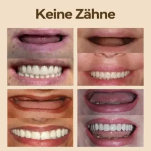 𝐇𝐢𝐝𝐨𝐧𝐞®🚀 – 🦷𝐏𝐫𝐞𝐦𝐢𝐮𝐦 𝐆𝐞𝐛𝐢𝐬𝐬🦷（✨Geeignet für alle Mundformen, speziell angefertigte Zahnersätze für die perfekte Passform✨）