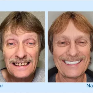 𝐇𝐢𝐝𝐨𝐧𝐞® – 🦷𝐅𝐨𝐫𝐭𝐬𝐜𝐡𝐫𝐢𝐭𝐭𝐥𝐢𝐜𝐡 𝐌𝐚ß𝐠𝐞𝐟𝐞𝐫𝐭𝐢𝐠𝐭 𝐕𝐨𝐥𝐥𝐩𝐫𝐨𝐭𝐡𝐞𝐬𝐞𝐧-𝐒𝐞𝐭