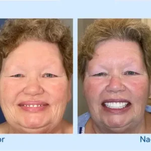𝐇𝐢𝐝𝐨𝐧𝐞® – 🦷𝐅𝐨𝐫𝐭𝐬𝐜𝐡𝐫𝐢𝐭𝐭𝐥𝐢𝐜𝐡 𝐌𝐚ß𝐠𝐞𝐟𝐞𝐫𝐭𝐢𝐠𝐭 𝐕𝐨𝐥𝐥𝐩𝐫𝐨𝐭𝐡𝐞𝐬𝐞𝐧-𝐒𝐞𝐭