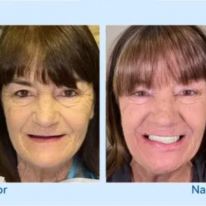 𝐇𝐢𝐝𝐨𝐧𝐞® – 🦷𝐅𝐨𝐫𝐭𝐬𝐜𝐡𝐫𝐢𝐭𝐭𝐥𝐢𝐜𝐡 𝐌𝐚ß𝐠𝐞𝐟𝐞𝐫𝐭𝐢𝐠𝐭 𝐕𝐨𝐥𝐥𝐩𝐫𝐨𝐭𝐡𝐞𝐬𝐞𝐧-𝐒𝐞𝐭