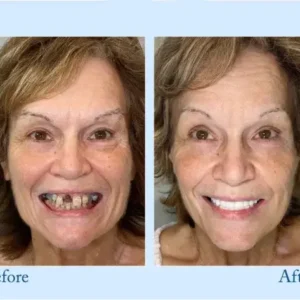 𝐇𝐢𝐝𝐨𝐧𝐞® 🦷Advanced Customized Full Denture Set🦷 (⏰Limited time discount last 30 minutes⏰)🍁🍁