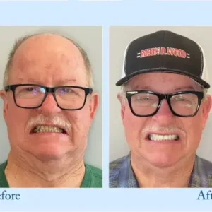 𝐇𝐢𝐝𝐨𝐧𝐞® 🦷Advanced Customized Full Denture Set🦷 (⏰Limited time discount last 30 minutes⏰)🍁🍁