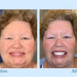 𝐇𝐢𝐝𝐨𝐧𝐞® 🦷Advanced Customized Full Denture Set🦷 (⏰Limited time discount last 30 minutes⏰)🍁🍁
