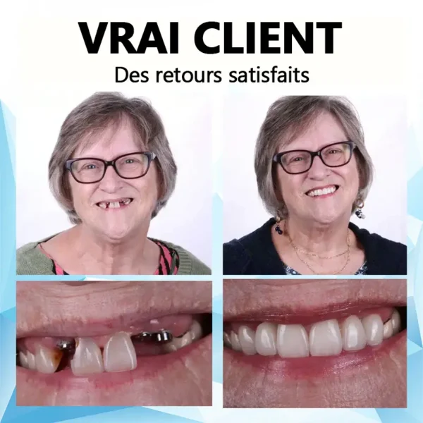 𝐁𝐢𝐤𝐞𝐧𝐝𝐚™ 🎈Kit de prothèses dentaires en silicone (⏰Remise à durée limitée Dernières 30 minutes）⏰