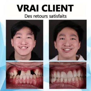 𝐁𝐢𝐤𝐞𝐧𝐝𝐚™ 🎈Kit de prothèses dentaires en silicone (⏰Remise à durée limitée Dernières 30 minutes）⏰