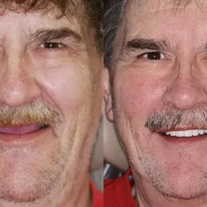 🦷Advanced Customized Full Denture Set🦷 (⏰Limited time discount last 30 minutes⏰)