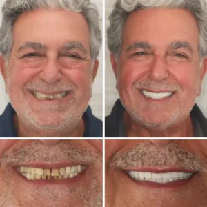 🦷Advanced Customized Full Denture Set🦷 (⏰Limited time discount last 30 minutes⏰)