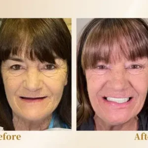 Hidone® –🦷Advanced Customized Full Denture Set🦷 (⏰Limited time discount last 30 minutes⏰)💎💎