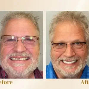 Hidone® –🦷Advanced Customized Full Denture Set🦷 (⏰Limited time discount last 30 minutes⏰)💎💎