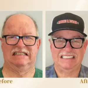 Hidone® –🦷Advanced Customized Full Denture Set🦷 (⏰Limited time discount last 30 minutes⏰)💎💎