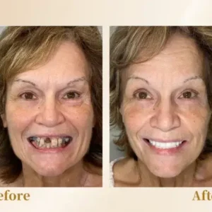 Hidone® –🦷Advanced Customized Full Denture Set🦷 (⏰Limited time discount last 30 minutes⏰)💎💎
