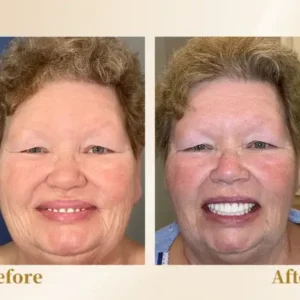 Hidone® –🦷Advanced Customized Full Denture Set🦷 (⏰Limited time discount last 30 minutes⏰)💎💎
