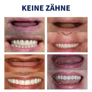 NESLEMY™-🦷 Fortgeschrittenes, maßgeschneidertes Vollprothesen-Set 🦷 (⏰ Limitierter Rabatt, nur noch 30 Minuten verfügbar ⏰)