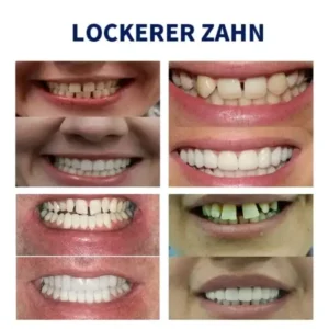 NESLEMY™-🦷 Fortgeschrittenes, maßgeschneidertes Vollprothesen-Set 🦷 (⏰ Limitierter Rabatt, nur noch 30 Minuten verfügbar ⏰)