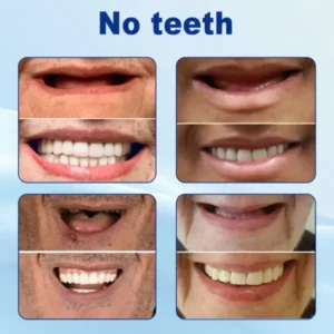 Nurbini® Advanced Customized Full Denture Set