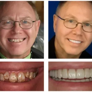 🦷 NESLEMY™ Custom-Fit Functional Dentures 😁 Smile with Confidence