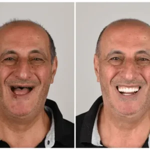 🦷 NESLEMY™ Custom-Fit Functional Dentures 😁 Smile with Confidence