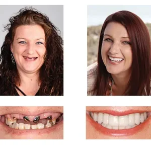 🦷 NESLEMY™ Custom-Fit Functional Dentures 😁 Smile with Confidence