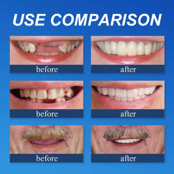 (Affordable Beauty🧏‍♀️🧏‍♂️)--NESLEMY™ --Advanced Customized Full Denture Set🦷