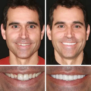 (Affordable Beauty🧏‍♀️🧏‍♂️)--NESLEMY™ --Advanced Customized Full Denture Set🦷