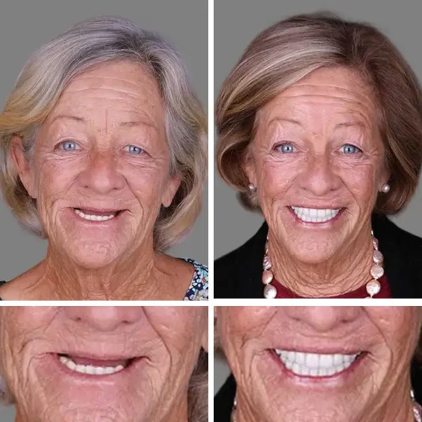 (Affordable Beauty🧏‍♀️🧏‍♂️)--NESLEMY™ --Advanced Customized Full Denture Set🦷