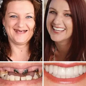 Clinclii™ –Advanced Customized Full Denture Set🦷