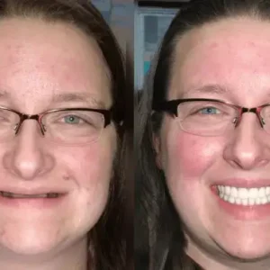 {Developed by Harvard University}🦷Advanced Customized Full Denture Set🦷