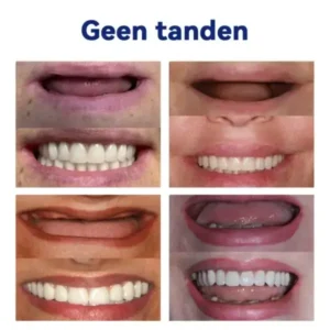 HEATWOLF™ Geavanceerde op maat gemaakte volledige protheseset🌸(Officieel aanbevolen product door de Belgische Tandartsenvereniging (BDA))🎁