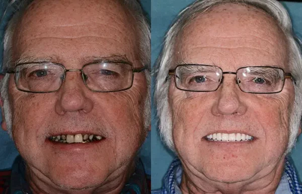 NESLEMY™ --🦷Advanced Customized Full Denture Set🦷