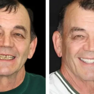 NESLEMY™ --🦷Advanced Customized Full Denture Set🦷