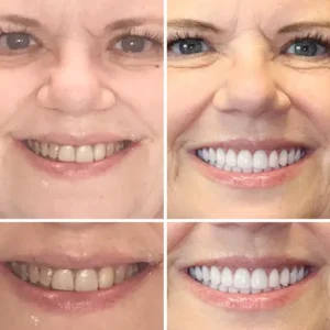 NESLEMY™ --🦷Advanced Customized Full Denture Set🦷