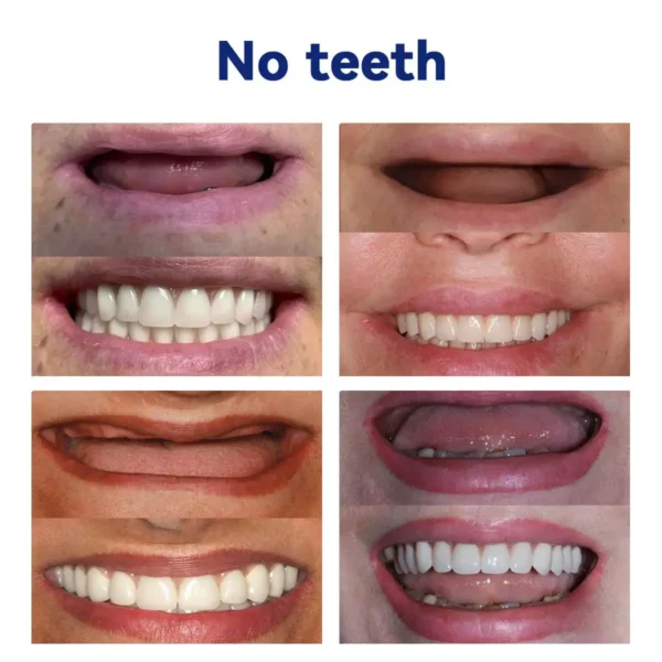 NESLEMY™-🦷Advanced Customized Full Denture Set🦷——Self-adsorbed in the mouth, comfortable to wear, worry-free chewing——your exclusive denture solution (⏰Limited time discount last 30 minutes⏰)