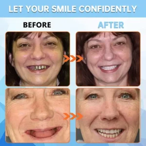 NESLEMY™-🦷Advanced Customized Full Denture Set🦷——Self-adsorbed in the mouth, comfortable to wear, worry-free chewing——your exclusive denture solution (⏰Limited time discount last 30 minutes⏰)